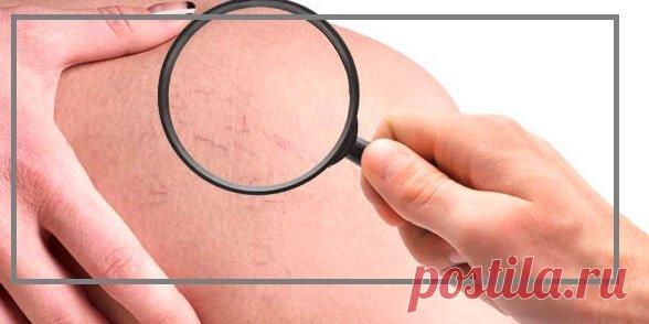 Простой способ: как убрать капиллярную сеточку на ногах и избавиться от отеков | моя записная книжка | Яндекс Дзен