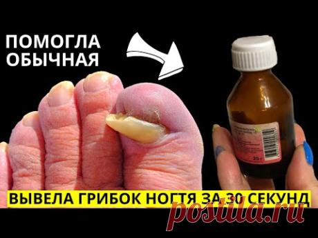 От ГРИБКА НОГТЕЙ можно Избавиться за 30 СЕКУНД простым... Это точно есть у всех дома!