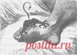 Подагра и мочевая кислота