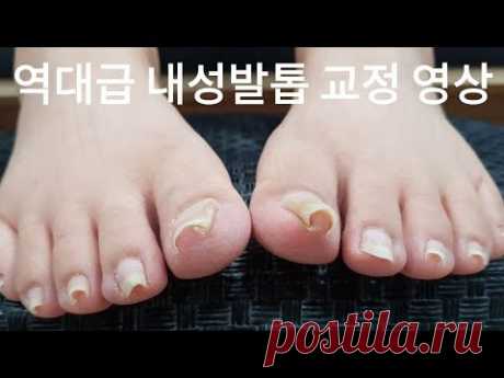 [시원함주의!!]😨이렇게 말릴수가 있나?😱역대급 내성 발톱 교정 영상!!👍왕건이 빼고 고객님 놀라심!!😱(ingrown toenail / toenails with fungus)