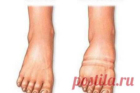 Отек ноги ниже колена: причины патологии