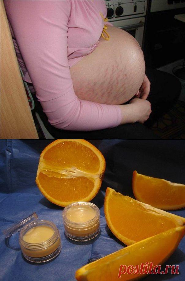 Изменения кожи (растяжки) во время беременности и после родов.