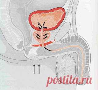 Prostatit to'qimasini muzlatish yoki isitish.