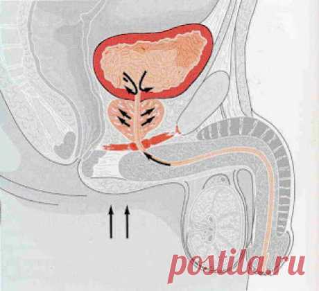 Prostatit to'qimasini muzlatish yoki isitish.