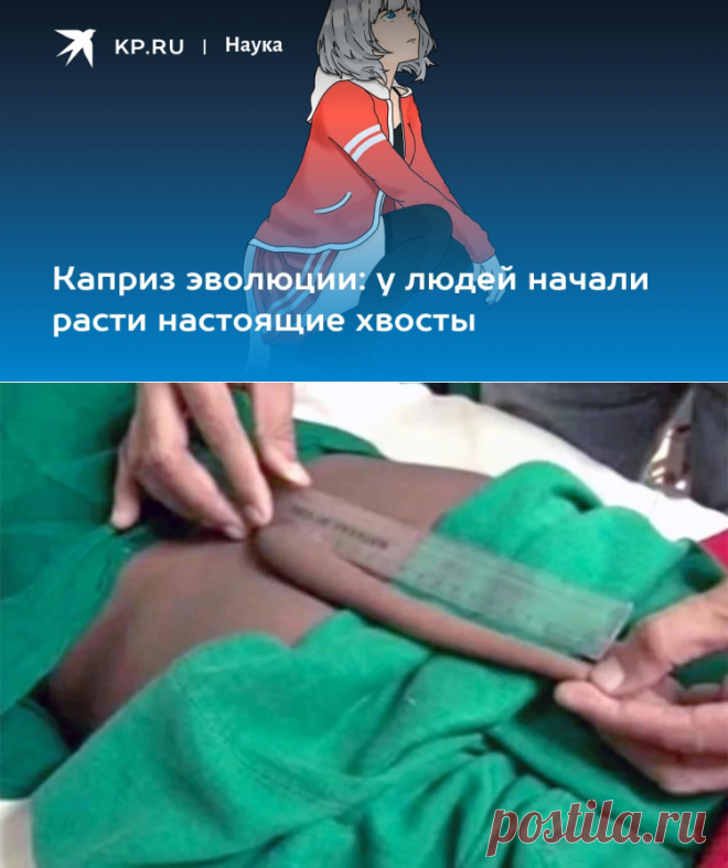 2022-Каприз эволюции: у людей начали расти настоящие хвосты - KP.RU