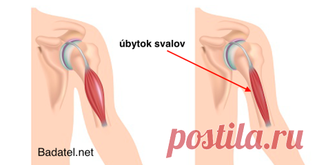 Dá sa vyliečiť nevyliečiteľná choroba akou je svalová dystrofia? Zdá sa, že áno! Svalová dystrofia sa považuje za nevyliečiteľné ochorenie. Je to naozaj tak alebo ho len medicína nemá záujem vyliečiť? To zistíte v článku.