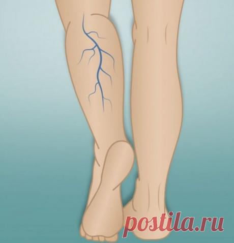 Хронические заболевания вен ног / Будьте здоровы