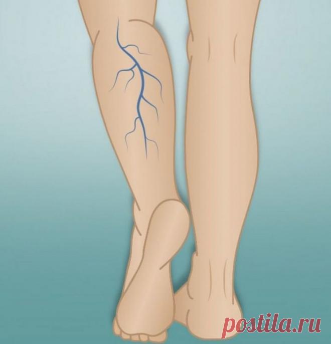 Хронические заболевания вен ног / Будьте здоровы