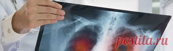 Рак легких ▷ лечение, признаки и симптомы рака легкого ⚕️ MedTour Рак легких ➤ диагностика, признаки, терапия и лечение рака легких ⚕️ Полное описание и новые методики лечения рака легких ⚕️ Все, что нужно знать про бронхогенную карциному ➤ какие симптомы заболевания, сколько стоит лечение рака легких ⚕️ Сколько стоит терапия рака легких узнайте в MedTour!