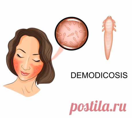 Демодекс: подкожные клещи на лице – что делать? | Всегда в форме!