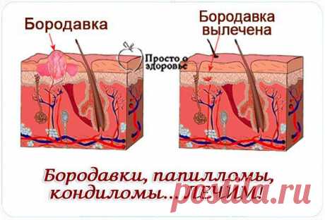 БОРОДАВКИ,КОНДИЛОМЫ,ПАПИЛЛОМЫ...??? ЛЕЧИМ.