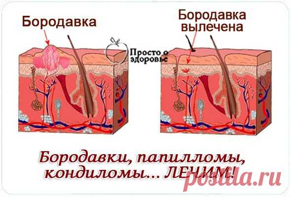 БОРОДАВКИ,КОНДИЛОМЫ,ПАПИЛЛОМЫ...??? ЛЕЧИМ.