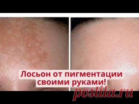 Вместо дорогой косметики от пигментных пятен! Отбеливающий лосьон от пигментации своими руками!
