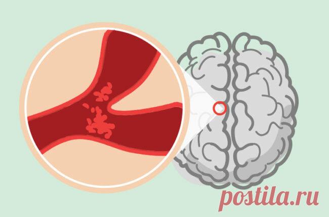Микроинсульт: симптомы, первые признаки и последствия | Клинический Институт Мозга | Яндекс Дзен