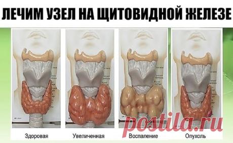 ЛЕЧИМ УЗЕЛ НА ЩИТОВИДНОЙ ЖЕЛЕЗЕ 

НАМ ПОТРЕБУЕТСЯ:

ГРЕЧНЕВАЯ КРУПА
ГРЕЦКИЕ ОРЕХИ
МЕД

Смешайте по одному стакану молотой гречневой крупы, пропущенных через мясорубку грецких орехов и меда в эмалированной (абсолютно чистой) посуде и переложите в стеклянную банку. Один раз в неделю за целый день съешьте этот состав, не принимая больше никакой пищи, кроме воды. 

Сделайте так шесть раз, т. е. шесть недель. Затем через месяц повторите лечение. Уже после первого курса зоб умен...