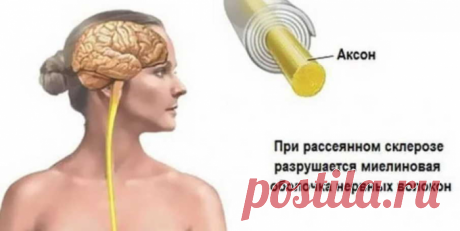 Народные средства для улучшения мозгового кровообращения: скажи «нет» слабоумию, рассеянности и немощи