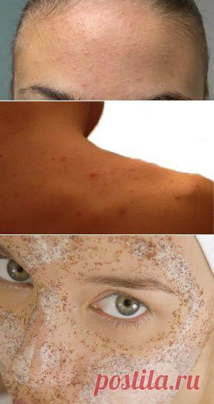 Угревая сыпь у подростка – что делать? - Сосед-Домосед