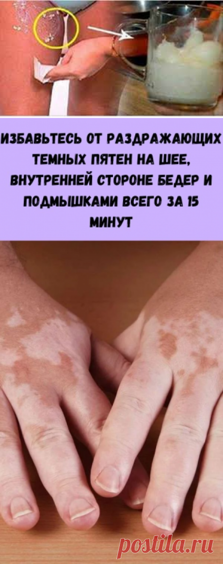 Избавьтесь от раздражающих темных пятен на шее, внутренней стороне бедер и подмышками всего за 15 минут - Счастливые заметки