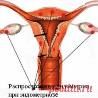 ​Лечение кольпита народными средствами