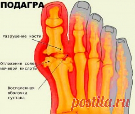 Диета при подагре на ногах и особенности правильного питания