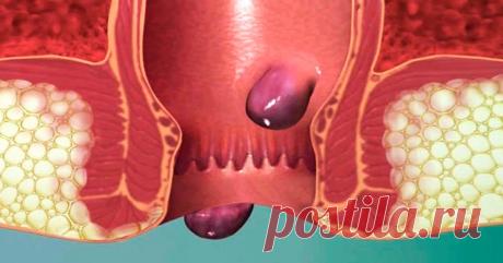 Вот почему возникает геморрой и 2 мощных старинных рецепта, которые избавят от этой проблемы раз и навсегда! Эти рецепты широко используются в народной медицине уже много лет. Мы предлагаем отличные рецепты для устранения геморроя. Она очень просто, недорого и эффективно! Все, что вам нужно, это...