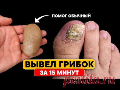 ГРИБОК НОГТЕЙ можно убрать за 15 минут обычным... Это есть дома у каждого