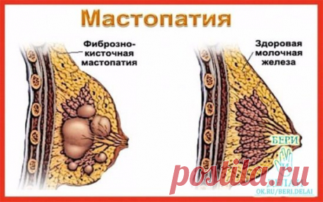 МАСТОПАТИЯ БОИТСЯ ВАЛЕРИАНЫ И ЗВЕРОБОЯ
Услышав от врачей диагноз «мастопатия», многие женщины впадают в отчаяние. И не случайно. Большинство не знает, как это заболевание лечить и как с ним жить. Доктора зачастую никакого лечения не предлагают. Советуют лишь проверять молочные железы каждый год, а вот если уплотнение начнет расти, тогда … придется, видимо, оперировать. Утешение, сами понимаете, слабое. А вот народная медицина знает немало естественных средств, с помощью которых можно облегчить с