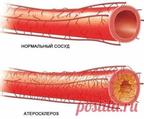 Как укрепить сосуды?

Спорт. Прежде всего, следует включить в распорядок дня, каким загруженным он ни был, физические упражнения. Утренние пробежки, занятия йогой, танцами, плаванием - все это будет отличной тренировкой для сосудов. Нагрузки должны быть умеренными, нельзя допускать переутомления и перенапряжения.

Рацион питания. Ежедневный рацион должен включать большое количество фруктов и овощей. К минимуму следует свести употребление жирных и жареных блюд, кофеинсодерж...