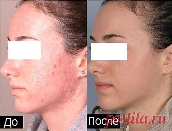 Избавляемся от прыщей и пятен на лице.