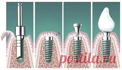 Имплантация зубов, цены на зубные импланты и восстановление зубов. | Zdorovie-L