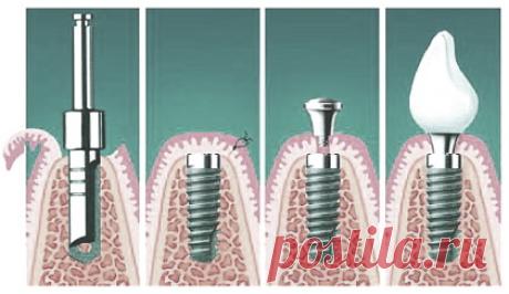 Имплантация зубов, цены на зубные импланты и восстановление зубов. | Zdorovie-L