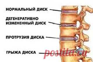 заострение замыкательных пластинок позвонков: 3 тыс изображений найдено в Яндекс.Картинках