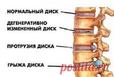 заострение замыкательных пластинок позвонков: 3 тыс изображений найдено в Яндекс.Картинках