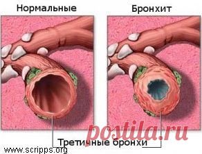Народные средства от кашля при бронхите.