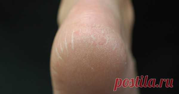 7 способов сделать пятки, как у младенца. Забудь про сухость и трещины!