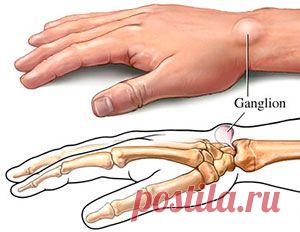 Гигрома. ПО «Луч-Ник», работая с организмом как с единым целостным механизмом, выявляет причины скопления внутрикистозного образования и создаёт условия для выведения из неё избыточной жидкости.