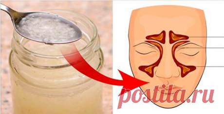 Эти 2 старинных рецепта избавят от простуды, гриппа, синусита, кашля, бронхита всего за пару дней! Эти средства действительно быстро помогают! Проверенно многими! Избавьтесь от заложенного носа и симптомов гриппа с этими 2 рецептами! Лук является отличным естественным противовоспалительным средством и может использоваться для лечения проблем с кожей, горлом, кишечником и