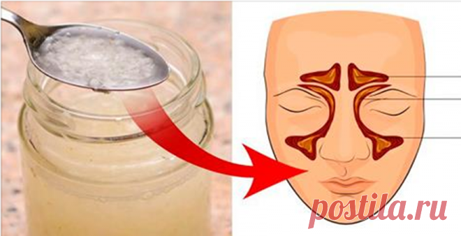 Эти 2 старинных рецепта избавят от простуды, гриппа, синусита, кашля, бронхита всего за пару дней! Эти средства действительно быстро помогают! Проверенно многими! Избавьтесь от заложенного носа и симптомов гриппа с этими 2 рецептами! Лук является отличным естественным противовоспалительным средством и может использоваться для лечения проблем с кожей, горлом, кишечником и