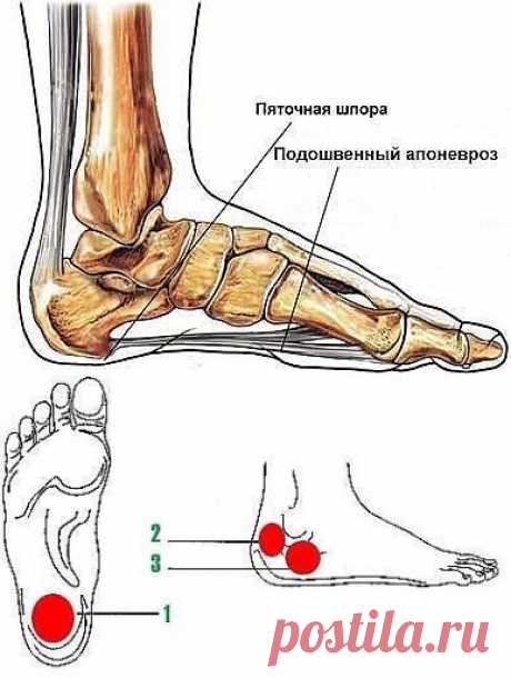 Народный рецепт лечения пяточной шпоры.