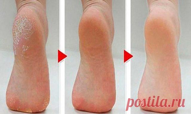 Очень хороший рецепт поможет тем, у кого шершавые руки, трещины на пятках, натоптыши, ногти на ногах «корявые» и «страшные». — Полезные советы