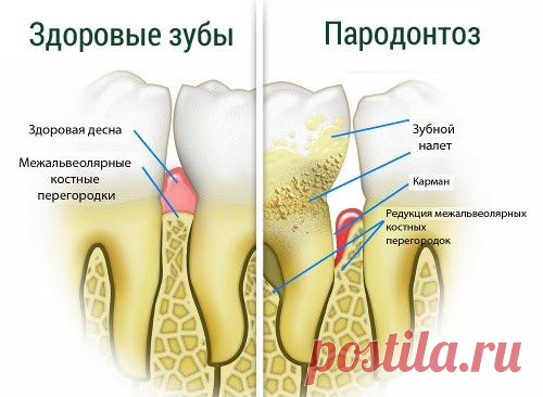 Пародонтоз — лечение в домашних условиях. | Познавательный сайт ,,1000 мелочей"