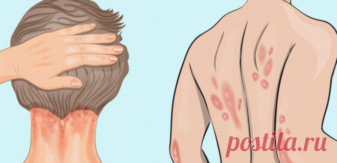 Псориаз: причины, симптомы и витамин, которого вам не хватает! - Счастливые заметки