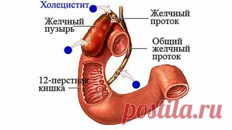 Симптомы и лечение острого и хронического воспаления желчного пузыря