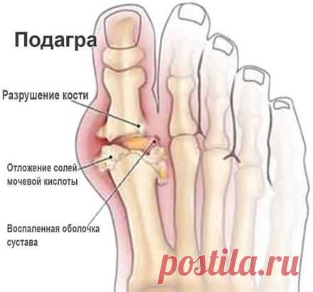 Лечим подагру