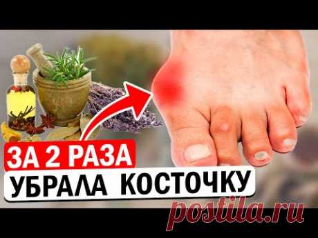 5 способов убрать косточку и понизить подагру
