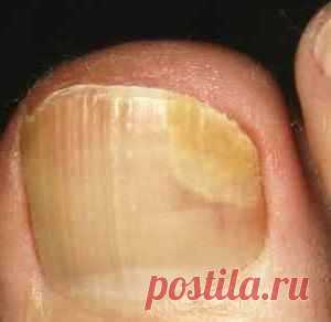 Эффективное лечение грибка ногтей ног солью.