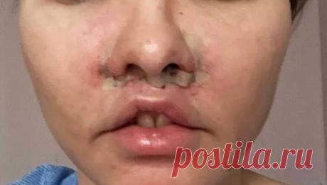 Пациентка отсудила 1,5 млн рублей у российской клиники за неудачную пластику губ. На Урале женщина после неудачной пластики губ отсудила у клиники 1,5 млн рублей. Об этом сообщает Telegram-канал "Медицинская Россия". Инцидент произошел в апреле 2024 года в екатеринбургской клинике "Бьюти Клаб" - ...