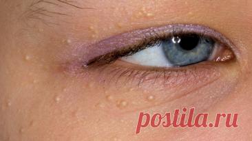 КАК ВЫВЕСТИ ЛИПОМУ (ЖИРОВИК)? САМЫЙ ЭФФЕКТИВНЫЙ МЕТОД НАРОДНОЙ МЕДИЦИНЫ — Journal women❜s