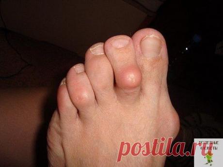 Наросты на костях пальцев.