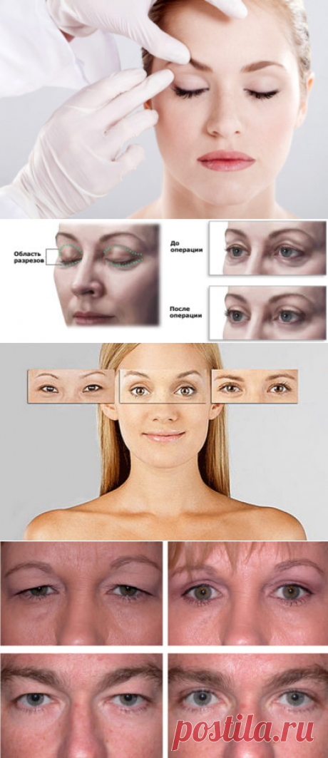 Блефаропластика, отзывы прооперированных